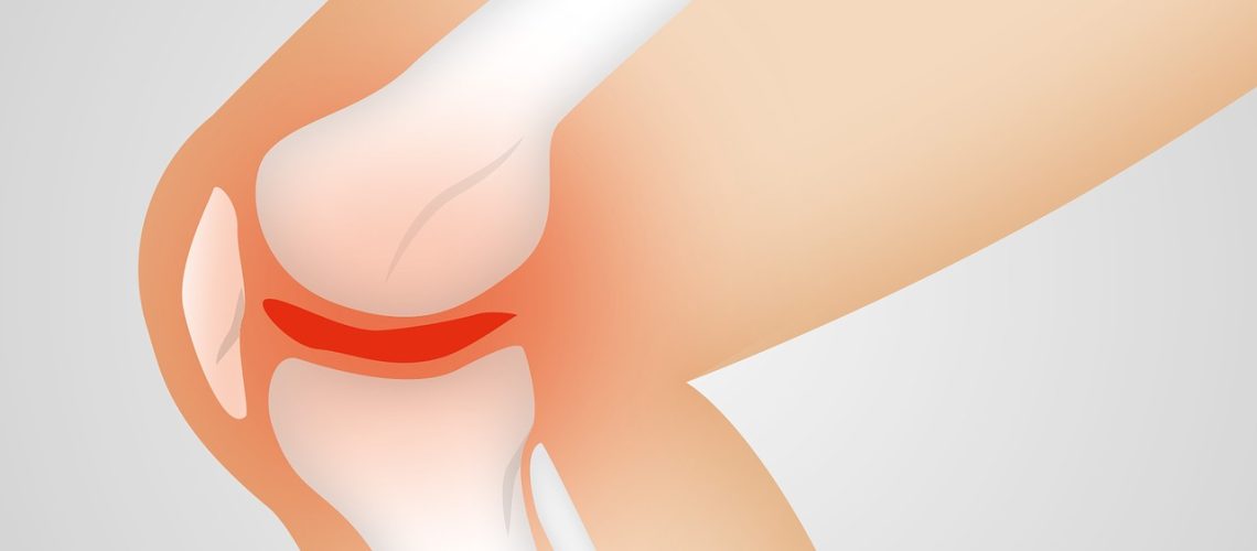 arthrocalman-2384254_1280